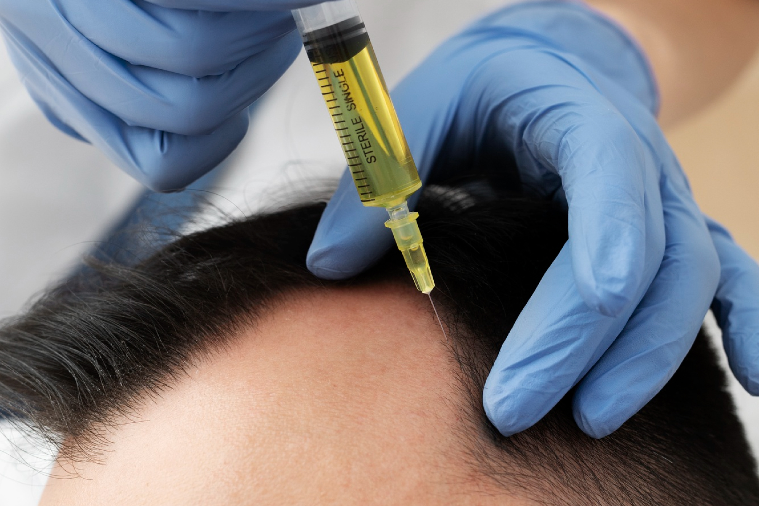 Мезотерапия для роста волос: как выбрать препараты